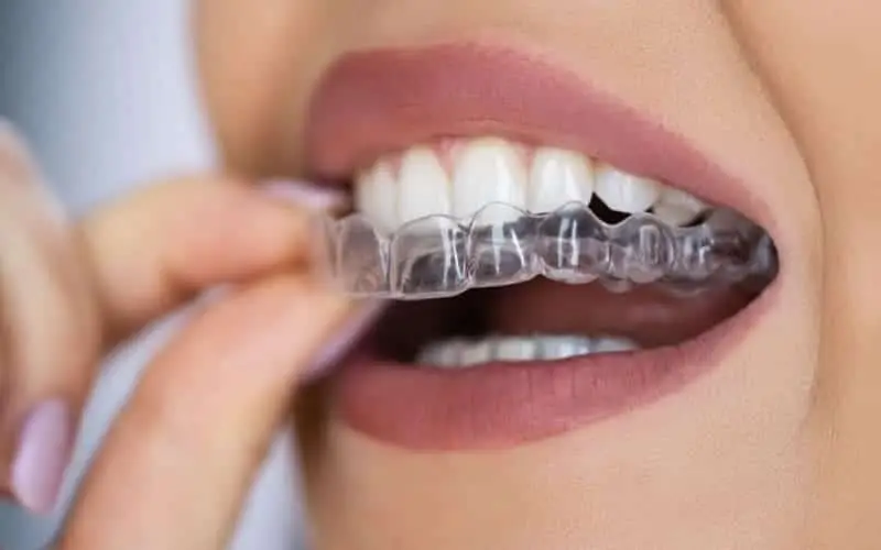 Woman inserting clear aligner tray at Luxe Smiles in Palmetto Bay FL