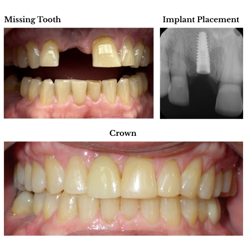 Dental implant before and after at Luxe Smiles in Palmetto Bay FL — missing tooth replaced with implant and porcelain crown